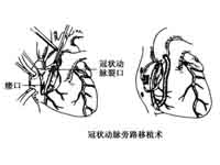 先天性冠狀動脈瘤