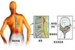 椎管內轉移性腫瘤
