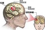 顱內腫瘤
