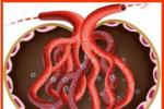急性腎小管壞死