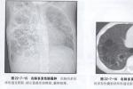 先天性支氣管囊腫