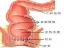 結腸糞性穿孔