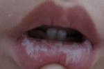 韋格內肉芽腫