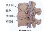 腰椎間盤突出