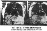 彌漫性胸膜間皮瘤