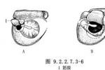 蟄伏脂瘤