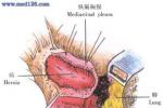 經膈肌肋間疝