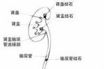 老年人泌尿系結石