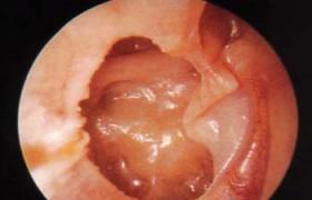 外耳道乳頭狀瘤