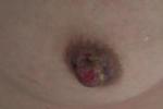 乳頭侵蝕性腺瘤病