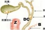 膽囊結石