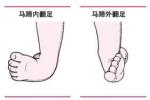 先天性仰趾外翻足