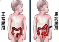小兒先天性巨結腸