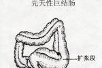 小兒先天性巨結腸