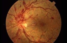 視網膜動脈栓塞