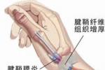 肌腱炎