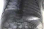 小兒腎結核
