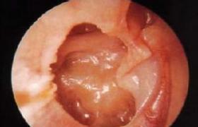 急性化膿性中耳炎