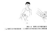 橈骨頭半脫位