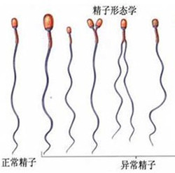 精子畸形