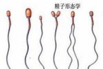 精子畸形