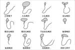 精子畸形