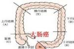 大腸癌