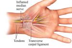 腕管綜合征