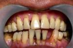 牙齦纖維瘤病