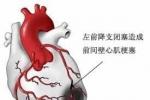 急性心肌梗死