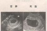 胎死宮內