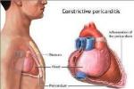 慢性縮窄性心包炎