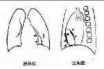 慢性縮窄性心包炎