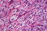 胸腺小細胞癌