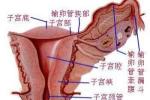 盆腔腹膜炎