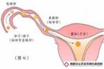 月經失調性不孕癥