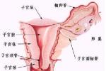 子宮內膜增生癥