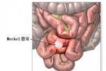 異位胰腺 異位胰腺