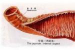 異位胰腺 異位胰腺
