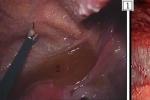結核性腹膜炎