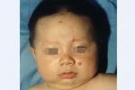 幼年性黃色肉芽腫