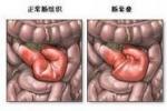 小兒動力性腸梗阻