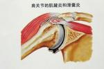 肩峰下滑囊炎