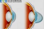 圓錐角膜