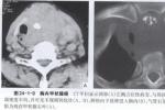 胸內甲狀腺腫
