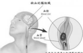 單發腦梗死性癡呆