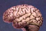 單發腦梗死性癡呆