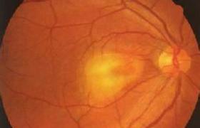 視網膜母細胞瘤
