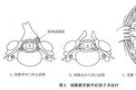 頸椎管狹窄癥