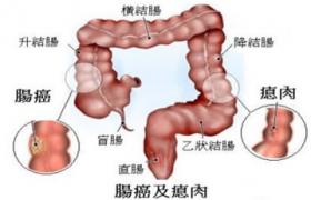 大腸類癌